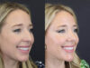 Facial Filler case #4115 slider thumbnail