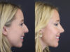 Facial Filler case #4115 slider thumbnail