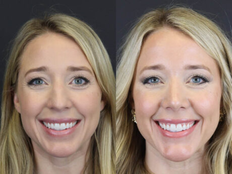 Facial Filler case #4115