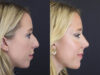 Facial Filler case #4115 slider thumbnail