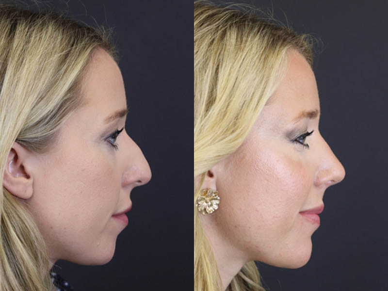 Facial Filler case #4115