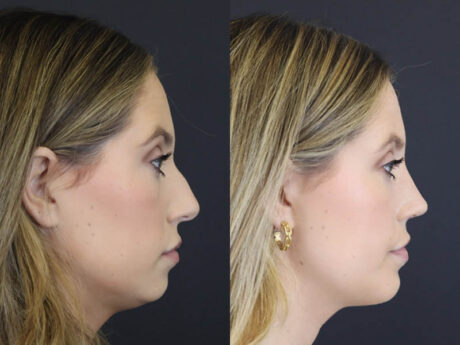 Chin Augmentation case #4143