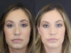 Chin Augmentation case #4143 slider thumbnail