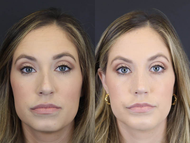 Chin Augmentation case #4143