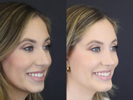 Chin Augmentation case #4143