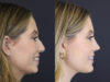 Chin Augmentation case #4143 slider thumbnail