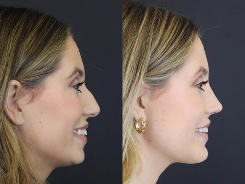 Chin Augmentation case #4143