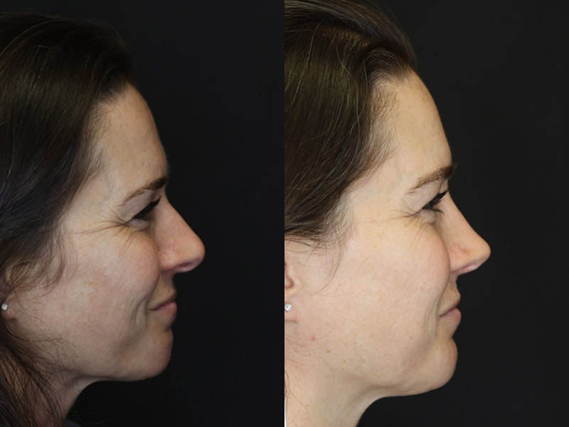 Rhinoplasty case #4163