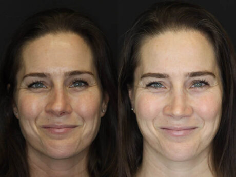 Rhinoplasty case #4163