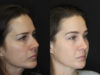 Rhinoplasty case #4163 slider thumbnail