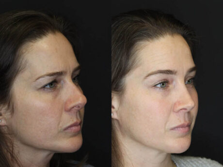 Rhinoplasty case #4163