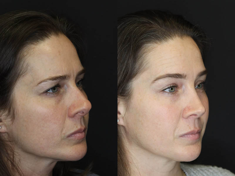 Rhinoplasty case #4163