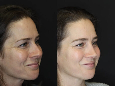 Rhinoplasty case #4163