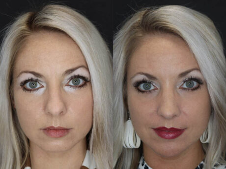 Rhinoplasty case #4191