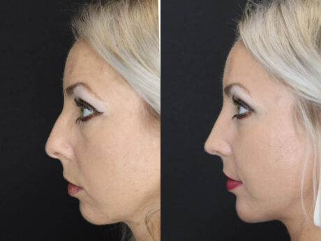 Rhinoplasty case #4191