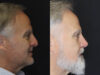 Rhinoplasty case #4196 slider thumbnail
