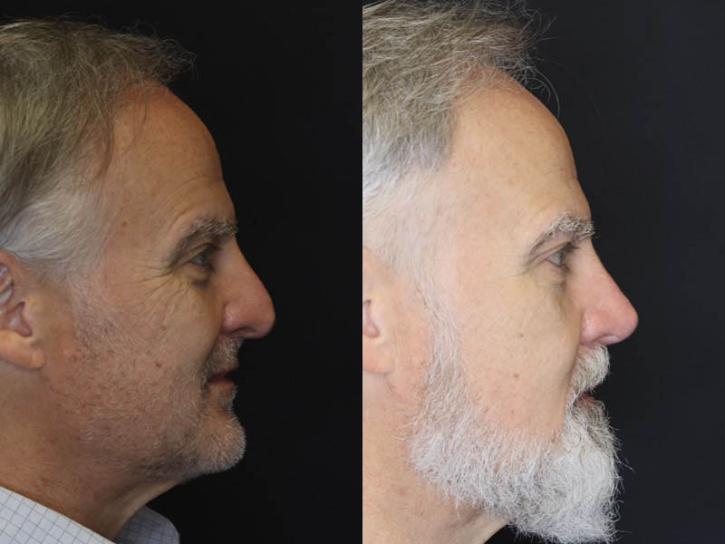 Rhinoplasty case #4196
