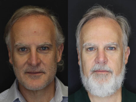 Rhinoplasty case #4196