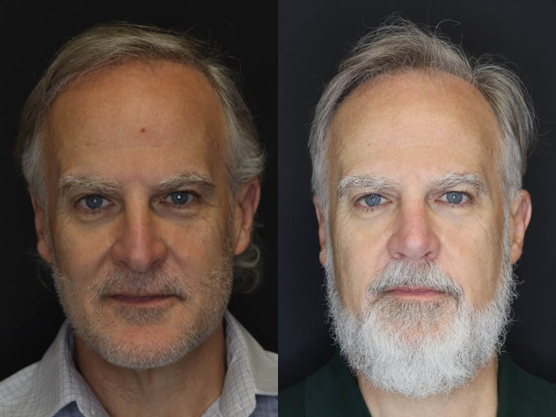 Rhinoplasty case #4196