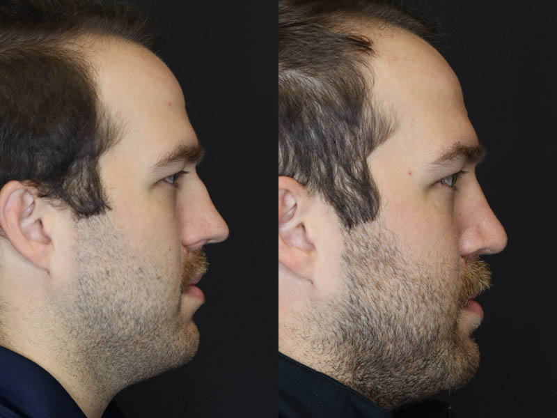 Rhinoplasty case #4203