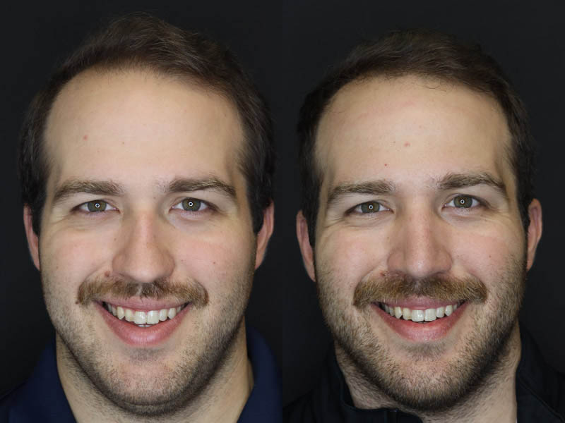 Rhinoplasty case #4203