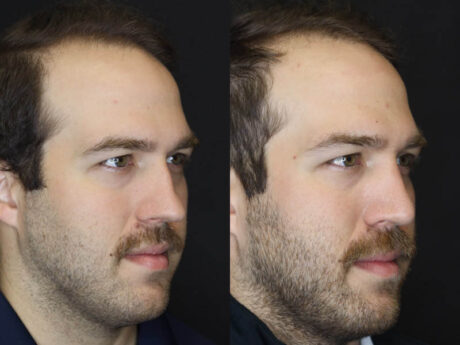 Rhinoplasty case #4203