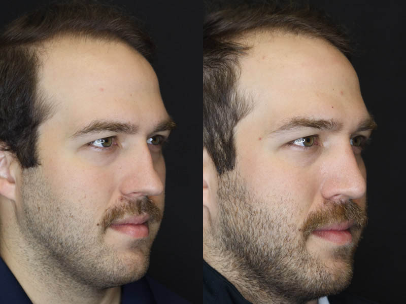 Rhinoplasty case #4203