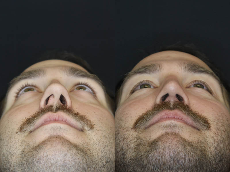 Rhinoplasty case #4203