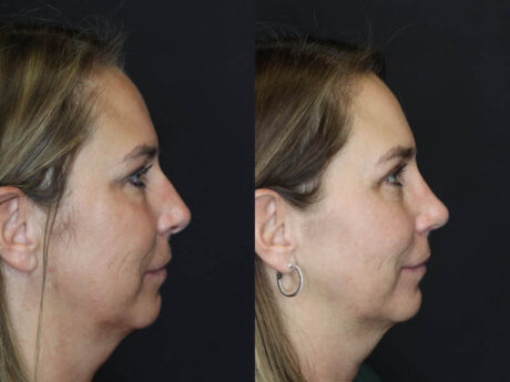 Rhinoplasty case #4212