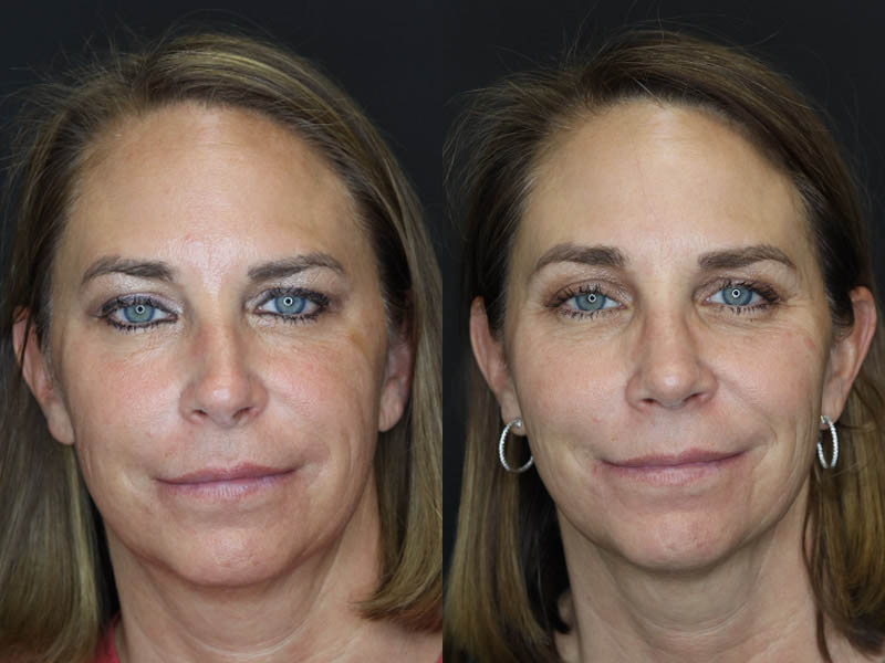 Rhinoplasty case #4212