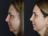 Rhinoplasty case #4212 slider thumbnail