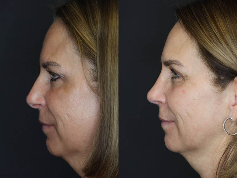 Rhinoplasty case #4212