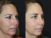 Rhinoplasty case #4212 slider thumbnail