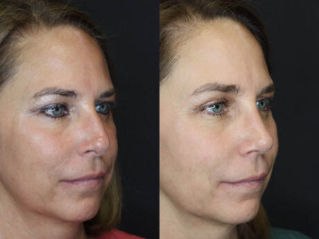 Rhinoplasty case #4212