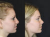 Rhinoplasty case #4237 slider thumbnail