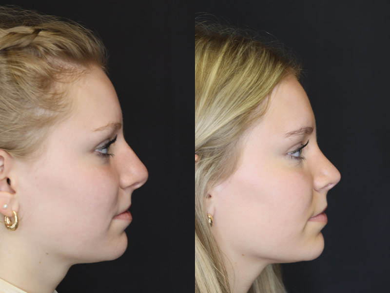 Rhinoplasty case #4237