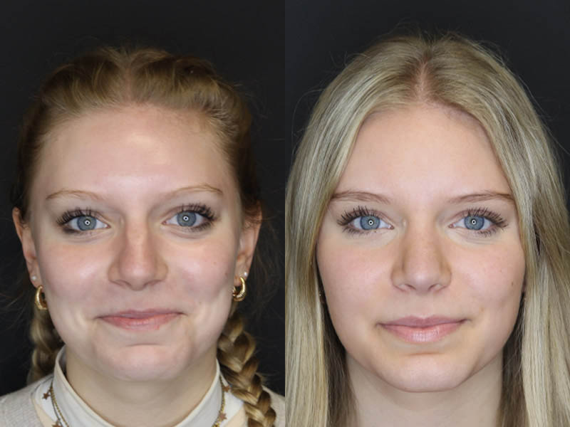 Rhinoplasty case #4237