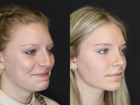 Rhinoplasty case #4237
