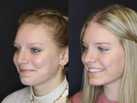 Rhinoplasty case #4237