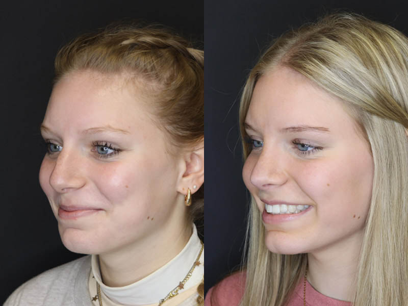 Rhinoplasty case #4237
