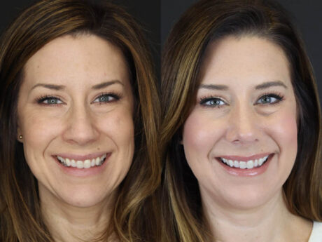 Rhinoplasty case #4252