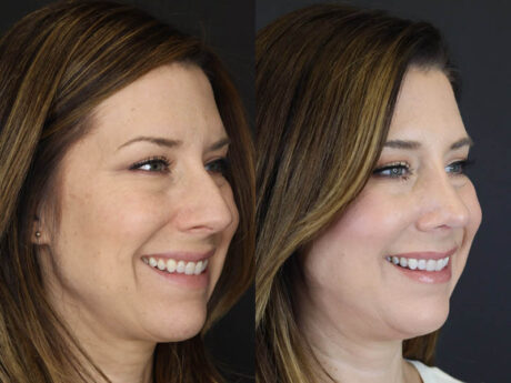 Rhinoplasty case #4252