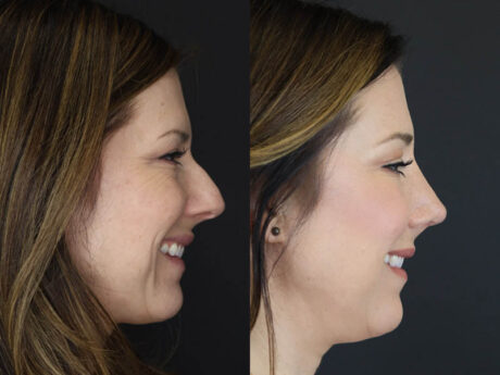 Rhinoplasty case #4252