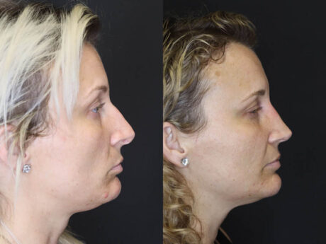 Rhinoplasty case #4265