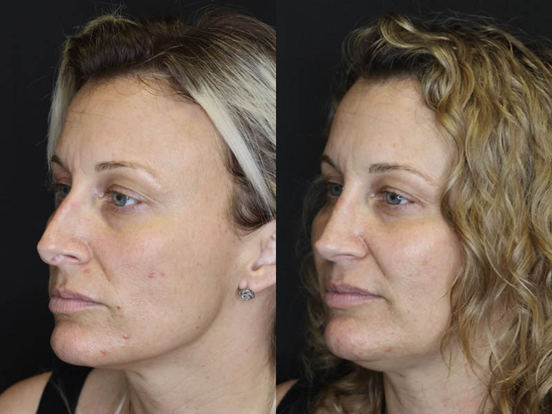 Rhinoplasty case #4265