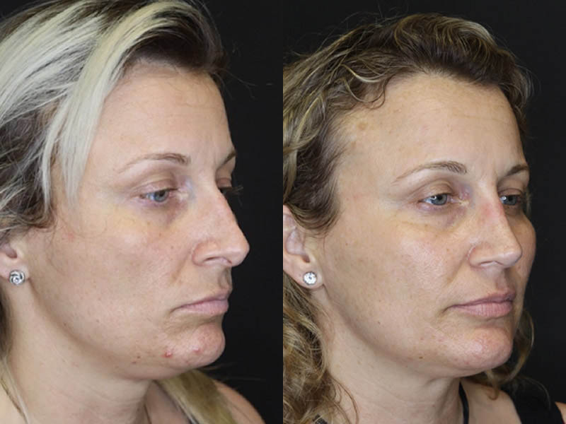 Rhinoplasty case #4265