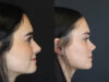 Rhinoplasty case #4321 slider thumbnail