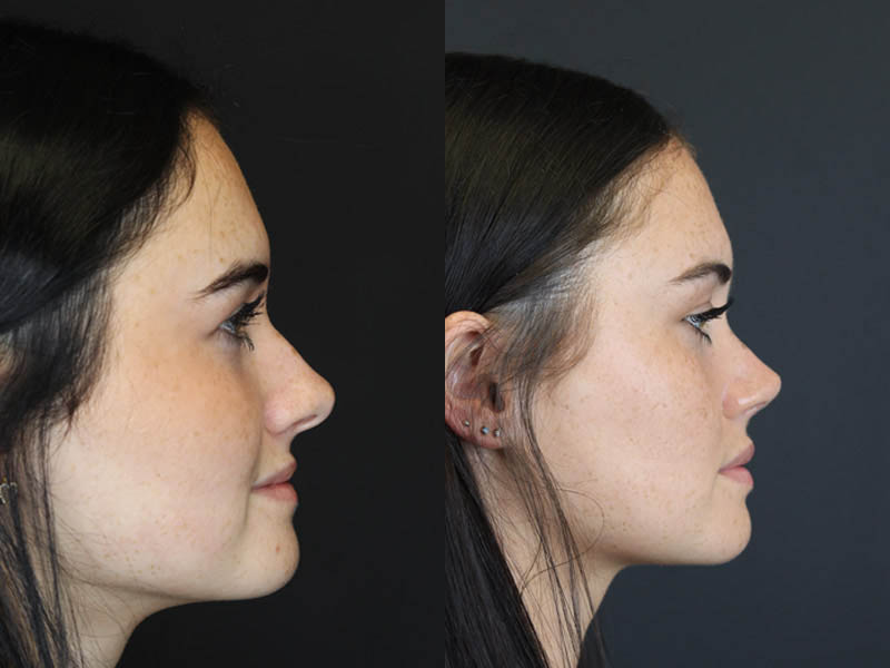 Rhinoplasty case #4321