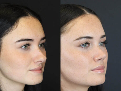 Rhinoplasty case #4321