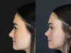 Rhinoplasty case #4321 slider thumbnail